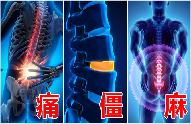 腰椎間盤(pán)突出最好的鍛煉方法有哪些